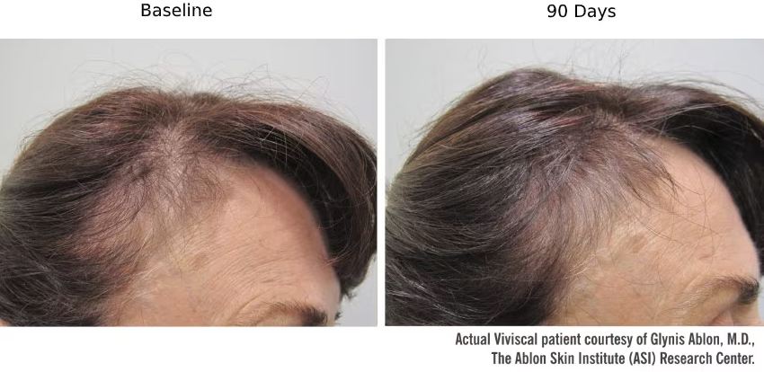 Viviscal before and after